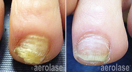 nail-fungus-before-after